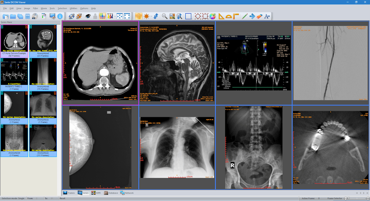 SanteDicomViewer - Created by PostDICOM